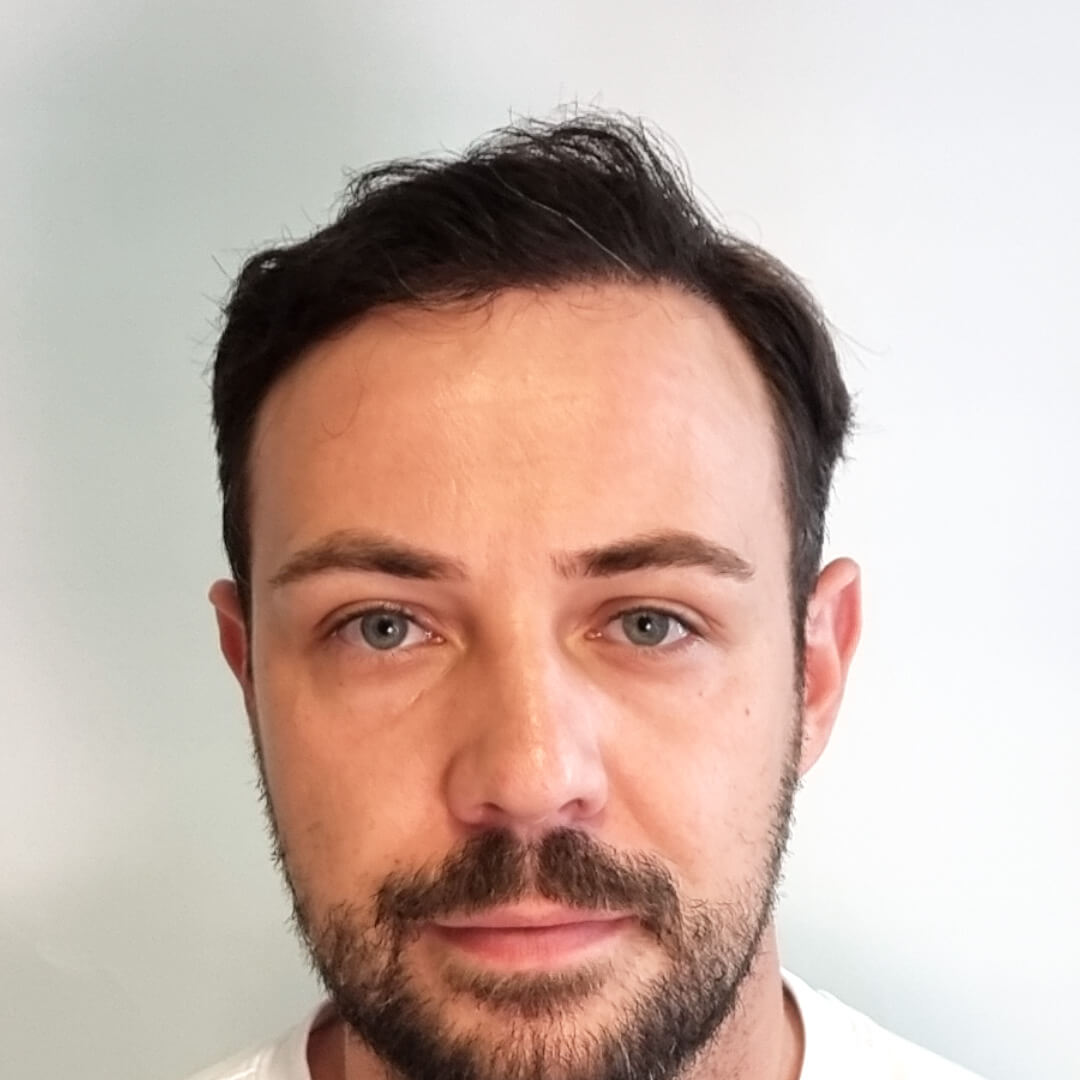 Haartransplantation erfahrungen – Mario