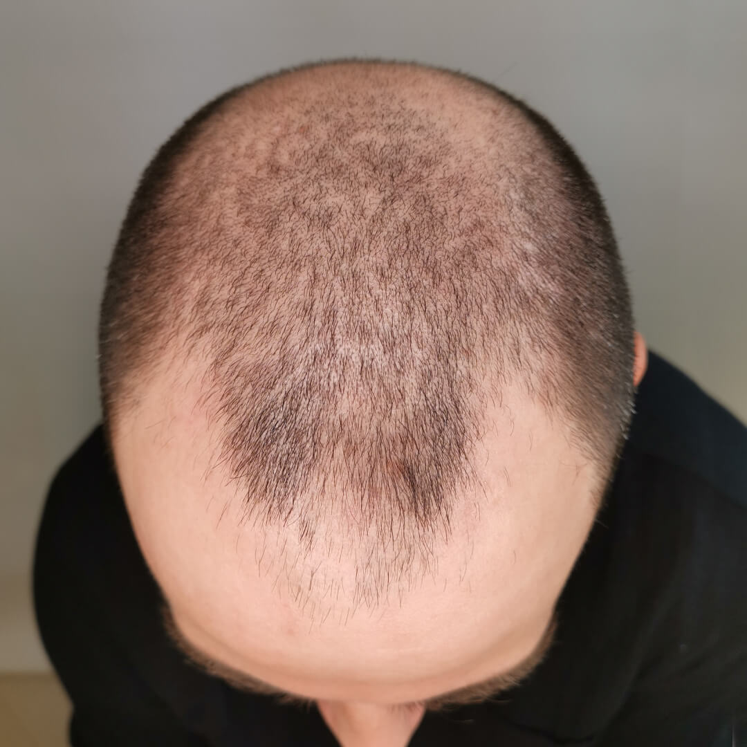 Haartransplantation erfahrungen – Mario