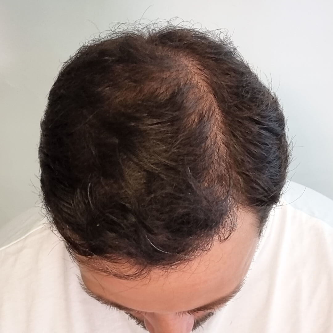 Haartransplantation erfahrungen – Mario