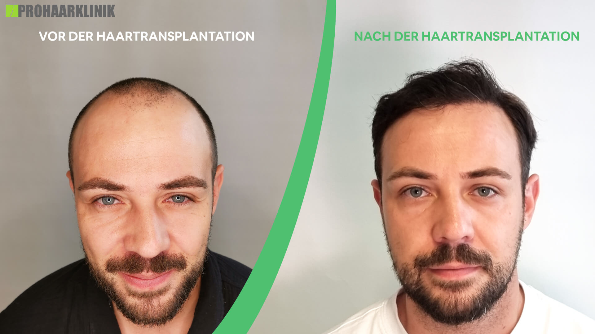 Haartransplantation vorher-nachher: Mario - PROHAARKLINIK nahe Wien